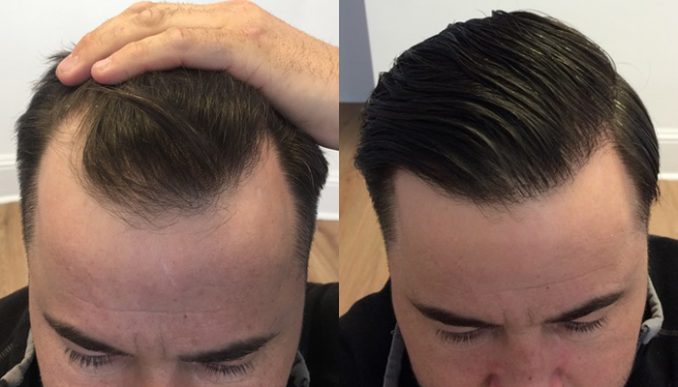The first haircut after a hair transplant: what you need to know - THE F :  THE F