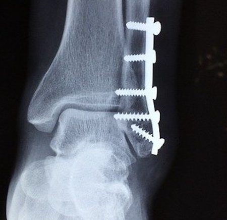 Ankle fracture