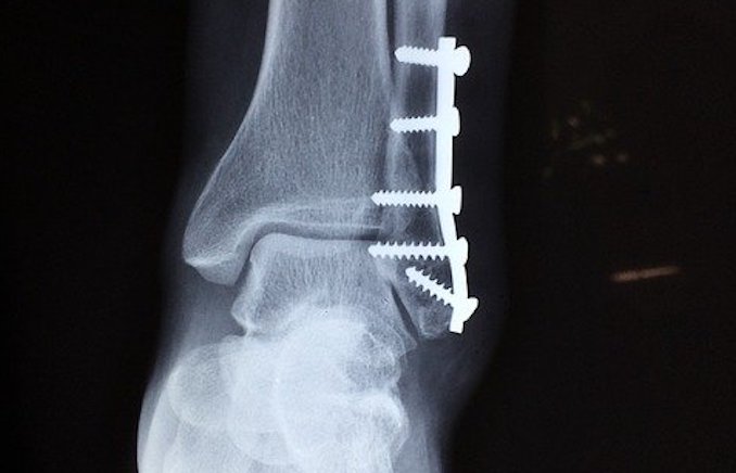 Ankle fracture
