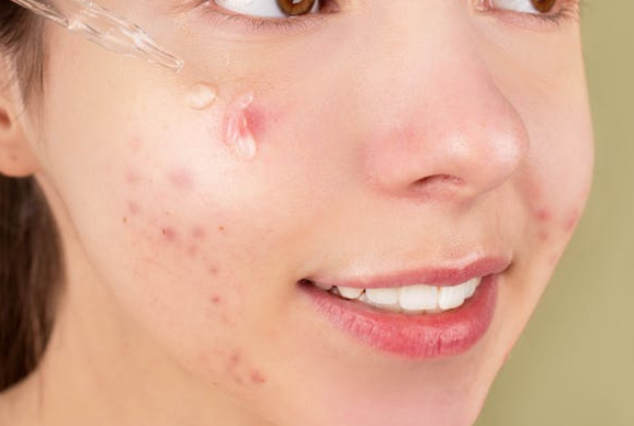 Woman face acne pimples